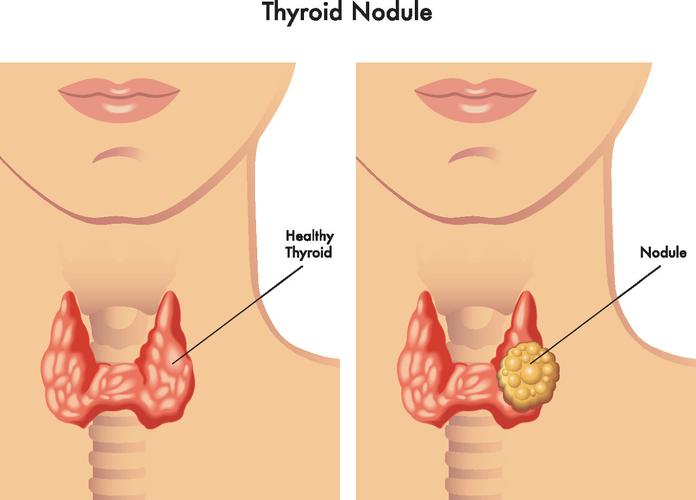 1.2 cm cystic and solid nodule on thyroid,Understanding the Nature of a 1.2 cm Cystic and Solid Nodule on Thyroid